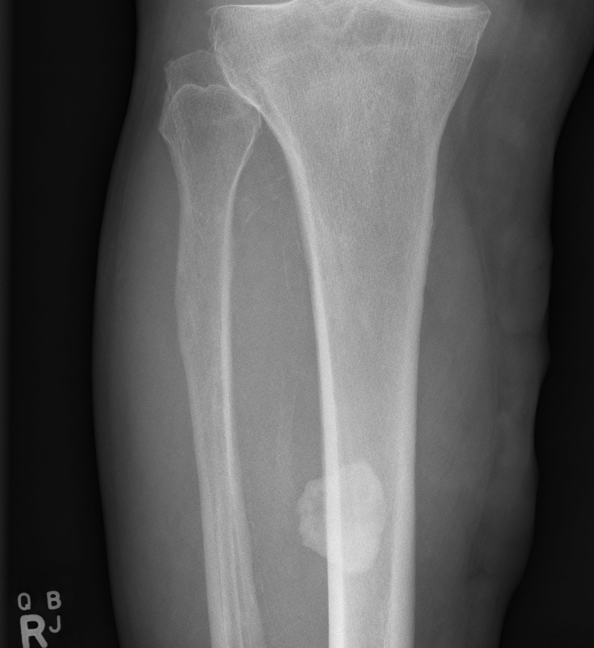 Tibial Myositis Ossificans AP